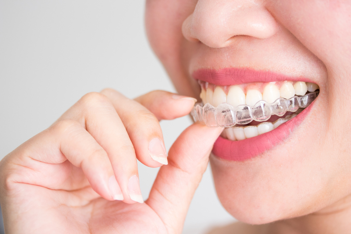 Invisalign braces